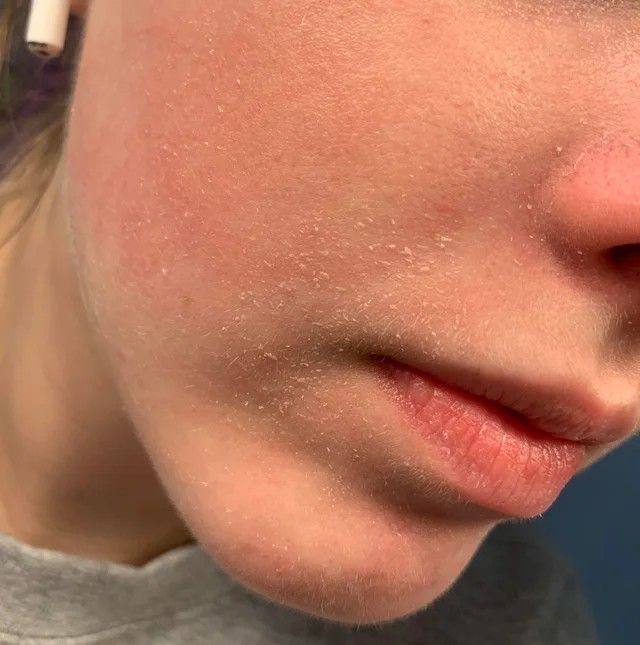 Dryness & Dehydration