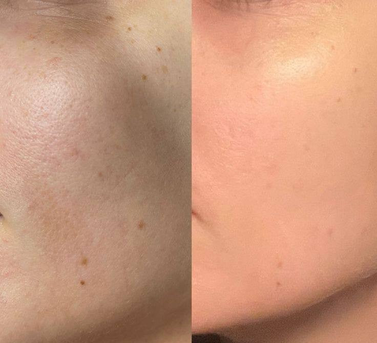 Dull & Uneven Skin Tone