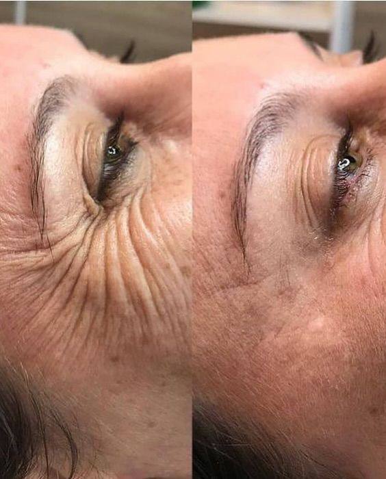 Anti-Aging & Fine Lines