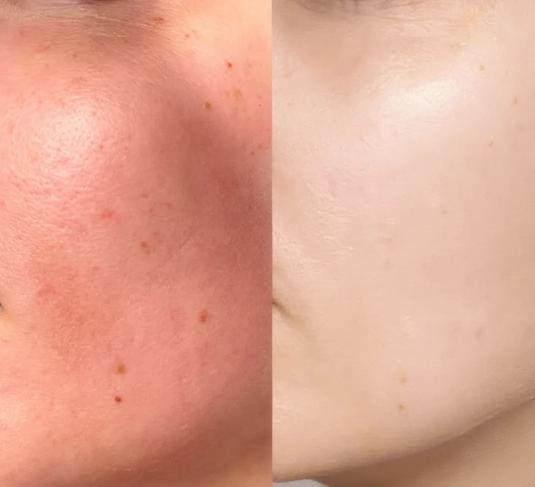 Sensitive & Irritated Skin